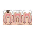 Caries. Stages of treatment of a tooth with a filling.